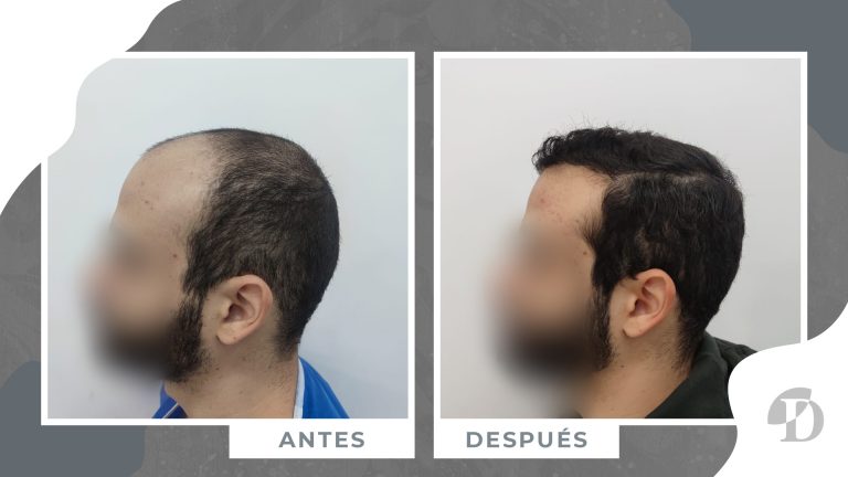 antes y despues cirugia capilar paciente 8 meses