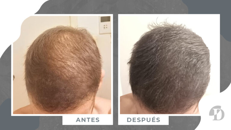 tratamiento tricologia clinica devesa valencia